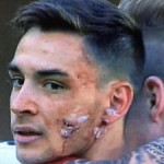 Il profondo taglio in faccia di Mattia De Sciglio durante Verona - Milan, foto calcioweb.eu